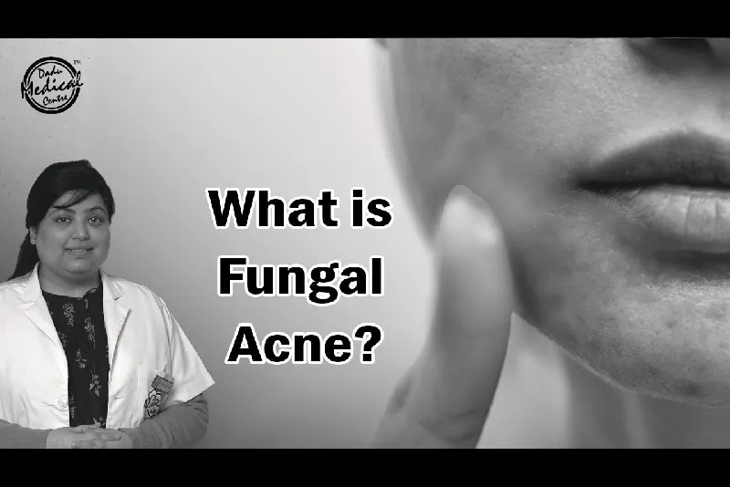 What is Fungal Acne? | How to Get Rid of Fungal Acne? | Fungal Acne Treatments | Dr. Nivedita Dadu