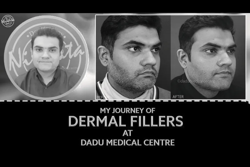 Dermal Fillers Treatment for Saggy Skin and Undereye Hollowness