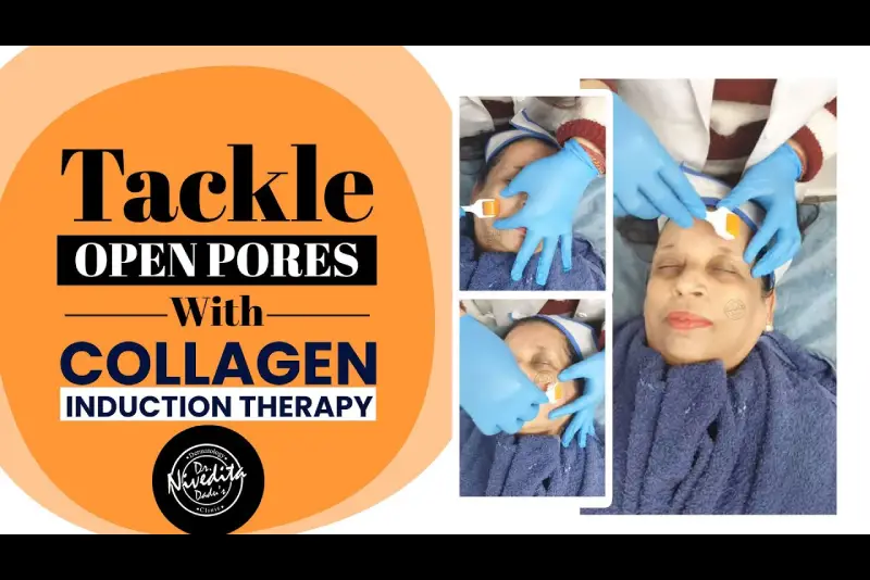Tackle Open Pores With Collagen Induction Therapy-Watch Live