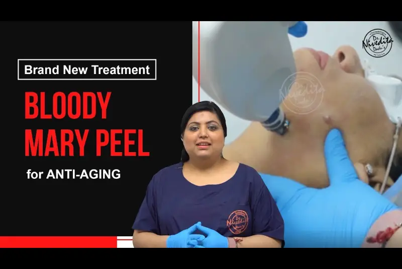 Single treatment for OpenPores, Finelines & Wrinkles: #BloodyMary Peel [Brand new Treatment] 2020