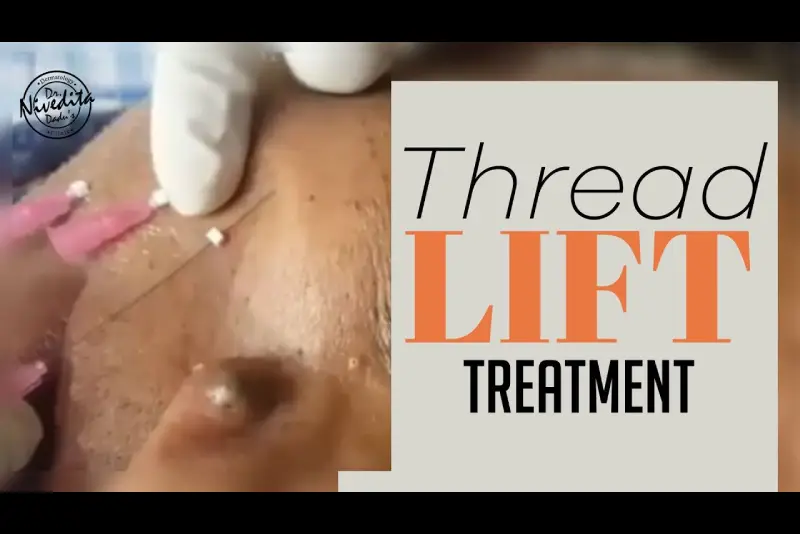 Thread Lift Treatment | Non Surgical Face Lift