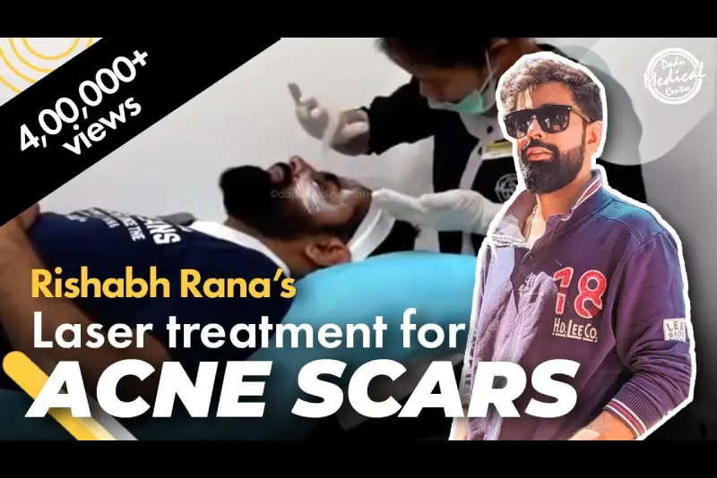 Advance Laser Treatments for Acne Scars | ‪@rishhsome‬ Laser Removal Treatment for Acne Scar