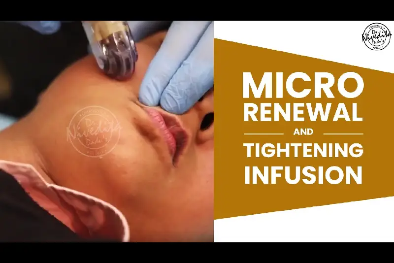 New Skin Treatment Launch | MARTINI | Complete Skin Rejuvenation with advanced Microneedling