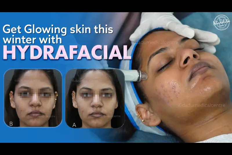 Hydrafacial treatment to cleanse, extract, and hydrate the skin.